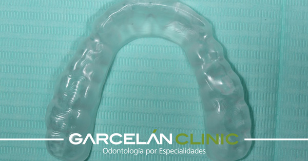 Claves para el cuidado y mantenimiento de tu férula de descarga - Garcelán  Clinic